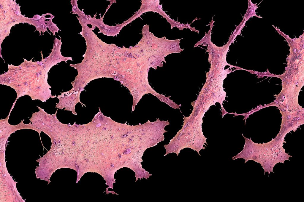 Inflammatory Breast Cancer